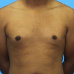 Gynecomastia Before & After Patient #2893