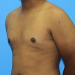 Gynecomastia Before & After Patient #2893