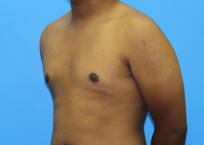 Gynecomastia Before & After Patient #2893