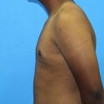 Gynecomastia Before & After Patient #2893