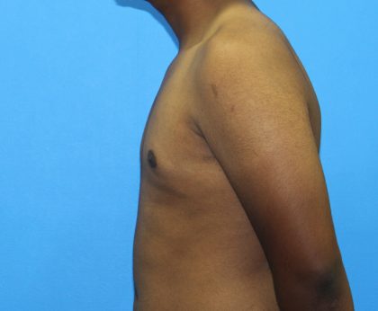 Gynecomastia Before & After Patient #2893