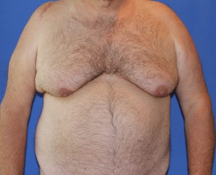 Gynecomastia Before & After Patient #2907