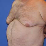 Gynecomastia Before & After Patient #2907