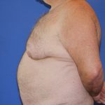 Gynecomastia Before & After Patient #2907