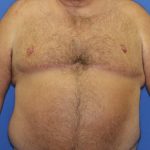 Gynecomastia Before & After Patient #2907