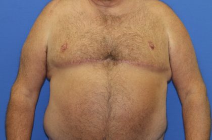 Gynecomastia Before & After Patient #2907