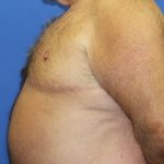 Gynecomastia Before & After Patient #2907