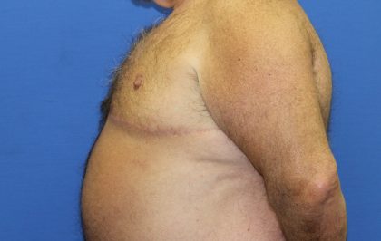 Gynecomastia Before & After Patient #2907