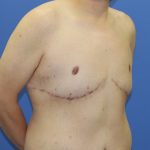 Gynecomastia Before & After Patient #2915