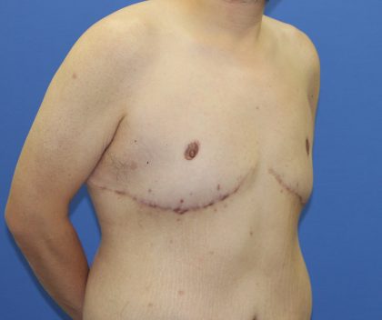 Gynecomastia Before & After Patient #2915