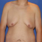 Gynecomastia Before & After Patient #2915