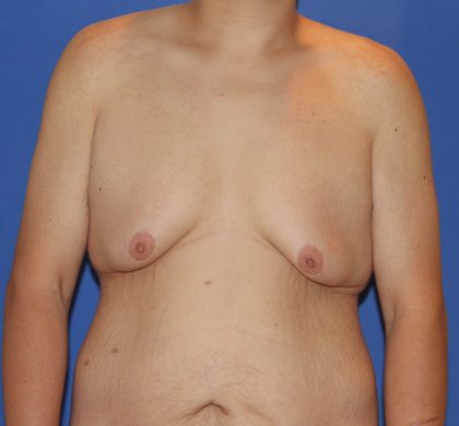 Gynecomastia Before & After Patient #2915