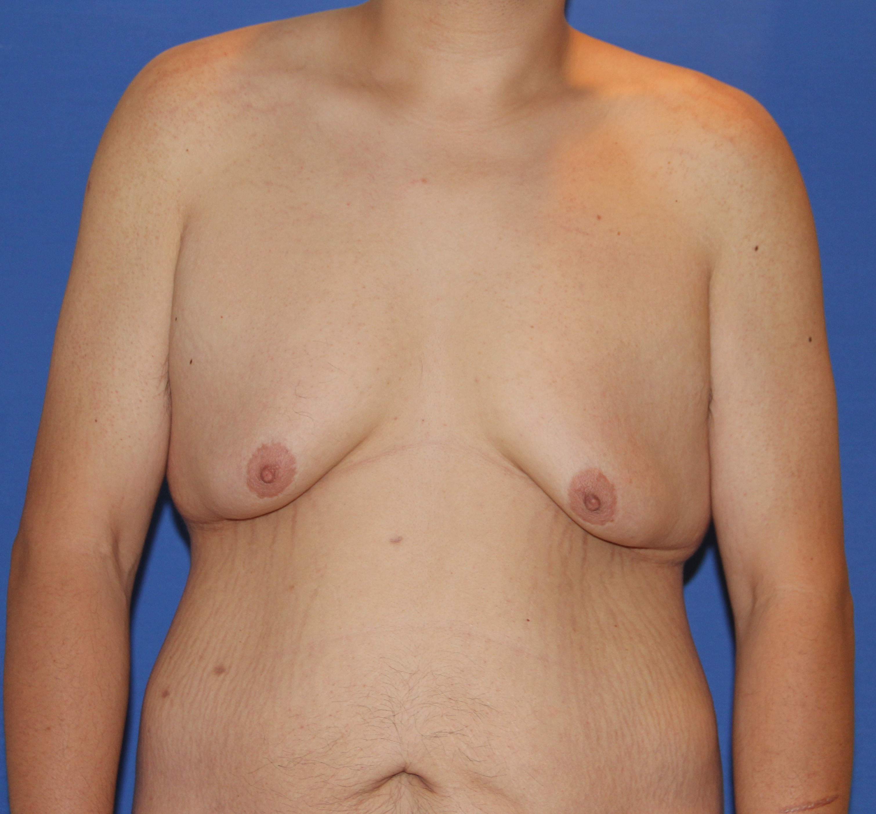 Gynecomastia Before & After Patient #2915