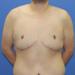 Gynecomastia Before & After Patient #2915