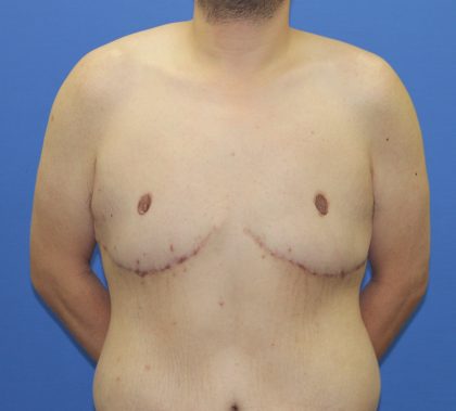 Gynecomastia Before & After Patient #2915