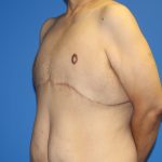 Gynecomastia Before & After Patient #2921