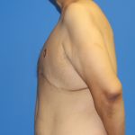 Gynecomastia Before & After Patient #2921