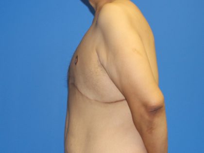 Gynecomastia Before & After Patient #2921