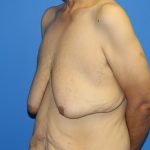 Gynecomastia Before & After Patient #2921