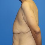 Gynecomastia Before & After Patient #2921