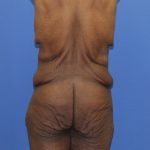 Lower Body Lift Before & After Patient #4161