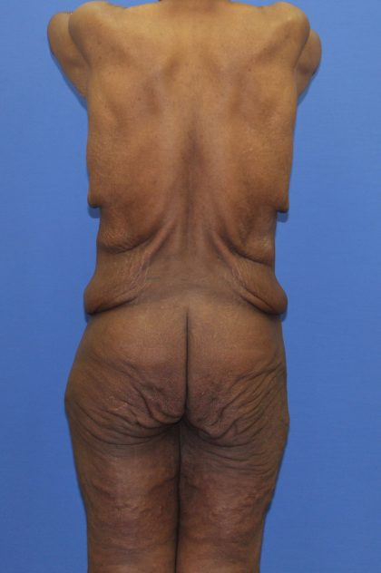 Lower Body Lift Before & After Patient #4161