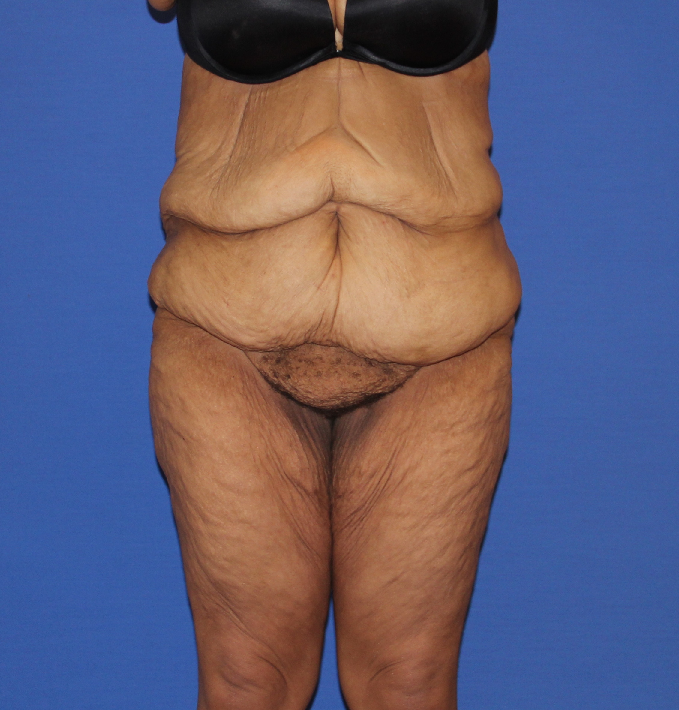 Lower Body Lift Before & After Patient #3986