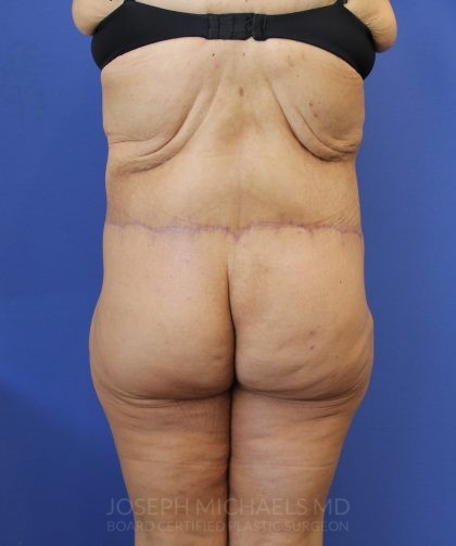 Lower Body Lift Before & After Patient #3986