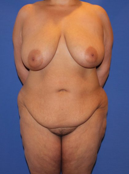 Tummy Tuck Before & After Patient #4170