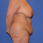 Tummy Tuck Before & After Patient #4170