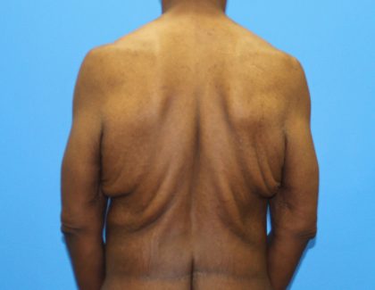 Back Lift (Upper Body Lift) Before and After Pictures Case 11677, Golden,  CO