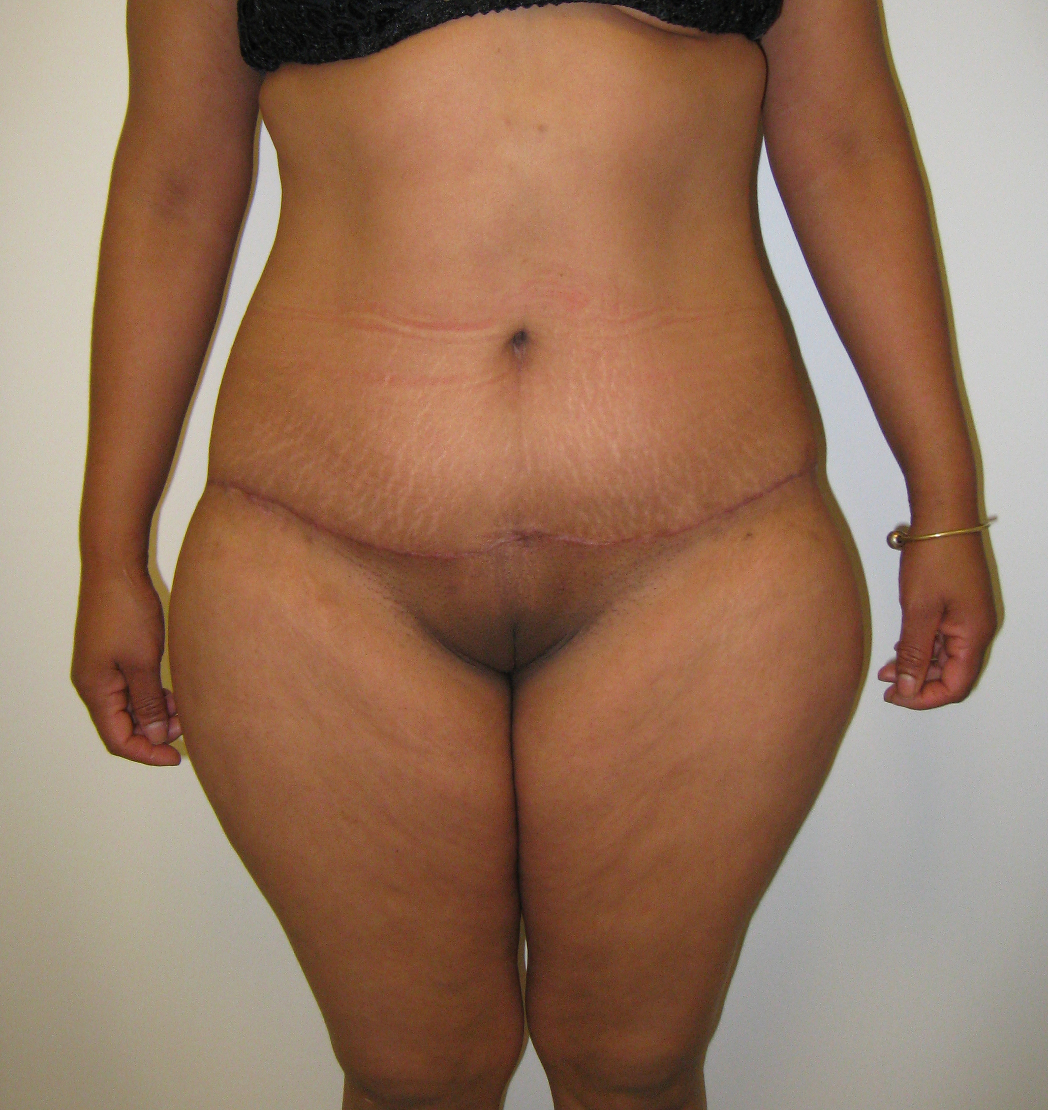 Lower Body Lift Before & After Patient #4044