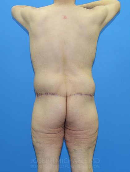 Lower Body Lift Before & After Patient #3997