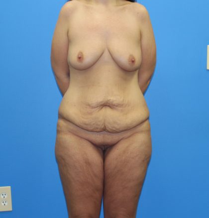 Lower Body Lift Before & After Patient #4028