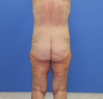 Lower Body Lift Before & After Patient #4059