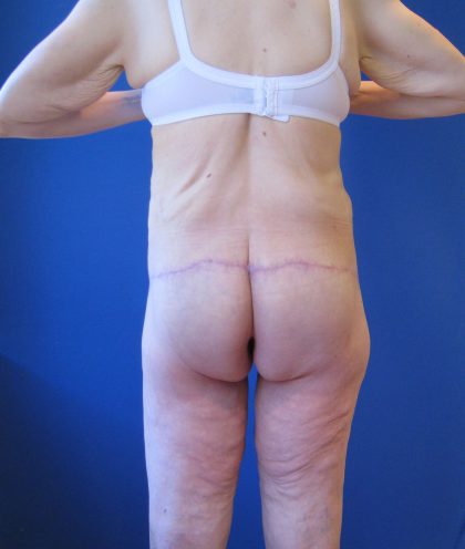 Lower Body Lift Before & After Patient #4068