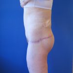 Lower Body Lift Before & After Patient #4068
