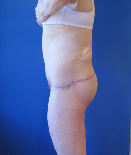 Lower Body Lift Before & After Patient #4068