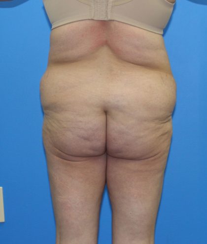 Lower Body Lift Before & After Patient #4079