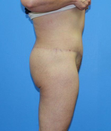 Lower Body Lift Before & After Patient #4079