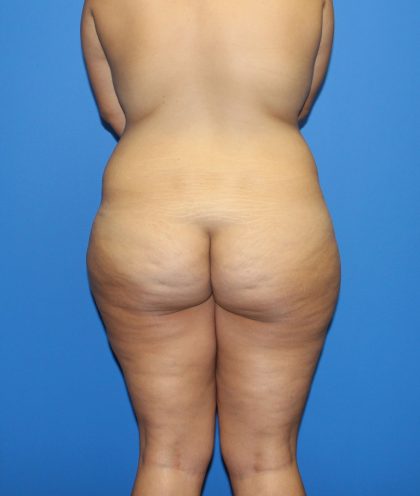 Lower Body Lift Before & After Patient #4097