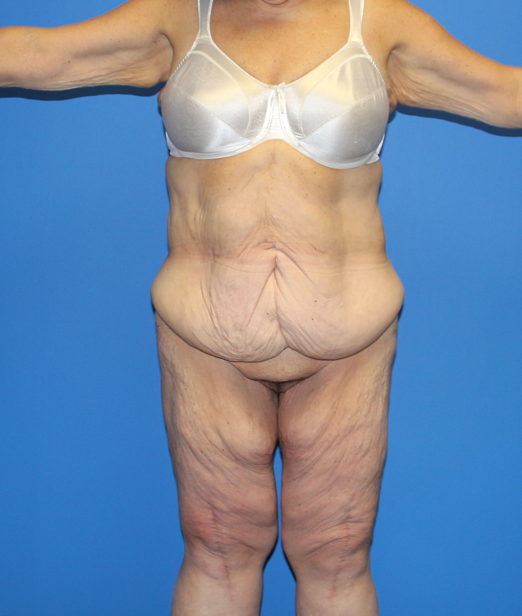 Lower Body Lift Before & After Patient #4106