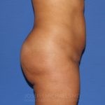 Buttock Augmentation Before & After Patient #3965