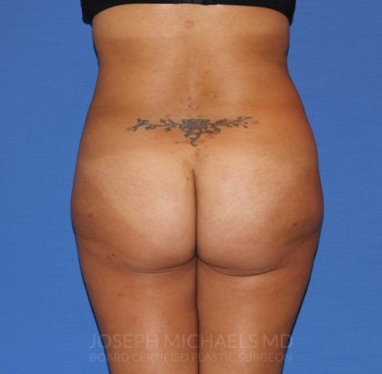 Buttock Augmentation Before & After Patient #3965