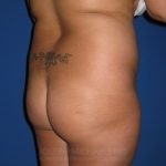 Buttock Augmentation Before & After Patient #3965