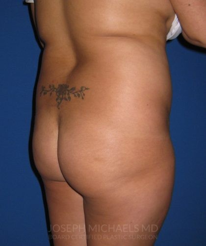 Buttock Augmentation Before & After Patient #3965