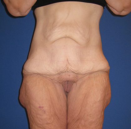 Extended Tummy Tuck Before & After Patient #4237