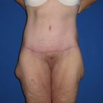 Extended Tummy Tuck Before & After Patient #4237