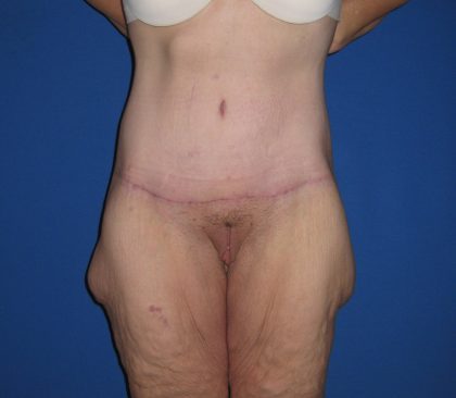 Extended Tummy Tuck Before & After Patient #4237