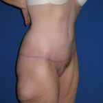 Extended Tummy Tuck Before & After Patient #4237